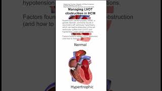 Managing left ventricular outflow tract LVOT obstruction in hypertrophic cardiomyopathy HCM [upl. by Nosreffej]