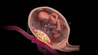 Medical science 3D animation  toxemia of pregnancy [upl. by Aylad]