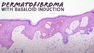 Dermatofibroma with basaloid follicular induction pathology mimic of basal cell carcinoma dermpath [upl. by Tarr920]