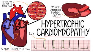 Hypertrophic Cardiomyopathy Made Easy  Includes Hypertrophic Obstructive Cardiomyopathy amp SAM [upl. by Anialahs]