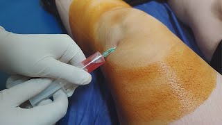 Knee fluid removal  Arthrocentesis  Synovial fluid aspiration procedure [upl. by Ramyar]