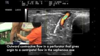 Outward contractive flow in a calf perforator in a healthy subject [upl. by Sonny]