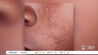 Local pediatrician advises parents on treating molluscum viral skin infection common with kids [upl. by Yemarej785]