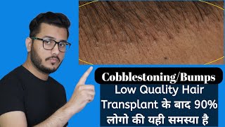 Low Quality Hair Transplant problem  Cobblestoning or Bumps after Hair Transplant [upl. by Airlia92]