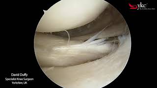 Watch a Knee Surgeon Treat a Meniscal Tear [upl. by Srednas]