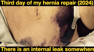 Day 3 of my most recent ventralumbilical repair revision I am leaking blood somewhere [upl. by Dray]