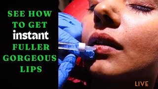 See How To Get Fuller GORGEOUS Lips Instantly With Juvederm Lip Filler lipaugmentation lipfiller [upl. by Lorre]