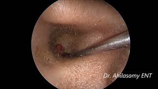 Very Rare Vascular tumor looking Foreign body R Ear in a 3 yrs child Endoscopic removal [upl. by Shelman968]