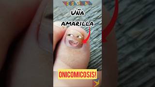 La Onicomicosis ⚠️ Explicado shortvideo [upl. by Ahselaf]