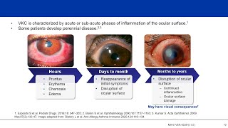 Understanding Vernal Keratoconjunctivitis VKC Not “Just an Allergy” [upl. by Erdnaxela]