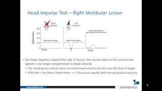 ICS Impulse vHIT Introduction and overview of underlying physiology [upl. by Sosthena]