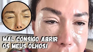 Peeling de Fenol Minha Experiência e Resultados Surpreendentes 😱✨ JOANNA MARIA [upl. by Dermott]