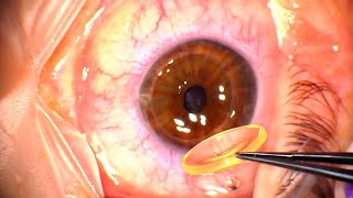 Corneal Transplant Penetrating Keratoplasty for Advanced Keratoconus and Corneal Infiltrates [upl. by Eceirehs]