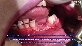 Vape pen explodes shattering teenagers jaw and knocking out some teeth [upl. by Uella742]