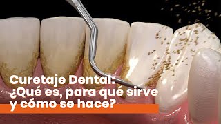 Curetaje Dental ¿Qué es y cómo se hace [upl. by Gearard]