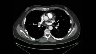 Tromboembolismo Pulmonar Angio tomografia [upl. by Imefulo]