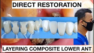 Step by step Layering Composite Lower Anterior  General Dentist Griya RR [upl. by Assille]