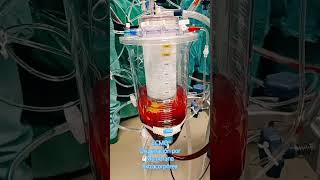 Oxigenación por membrana extracorpórea ECMO [upl. by Ahsrats]