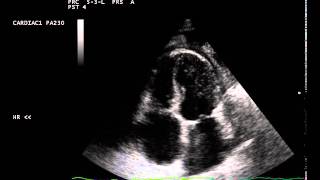 constrictive pericarditis septal bounce [upl. by Barron239]