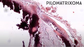 Pilomatrixoma under the microscope with calcification amp metaplastic bone ossification pathology [upl. by Omor]