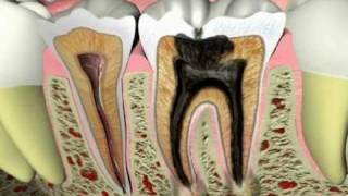 Endodontics  What Causes a Tooth Ache [upl. by Ecurb252]