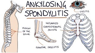 Ankylosing Spondylitis Visual Explanation for Students [upl. by Acinnej]