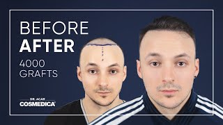 Excellent Before amp After Hair Transplant with Dr Acar [upl. by Ynaffyt221]