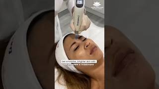 Dermapen 4 Treatment  Dermapen 4 for face  dermapen shortviral skincare shortsyoutube shorts [upl. by Caz240]