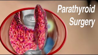 Parathyroid Surgery Traditional Open and Minimally Invasive Approaches [upl. by Einnus]