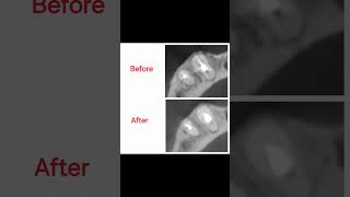 Healing of a periapical lesion encircling a mandibular canine [upl. by Inasah898]