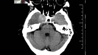 Head CT of Meningioma DISCUSSION by radiologist [upl. by Neal]