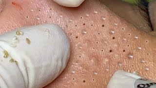 Big Cystic Acne Blackheads Extraction Blackheads amp Milia Whiteheads Removal Pimple Popping  1323 [upl. by Dustman]