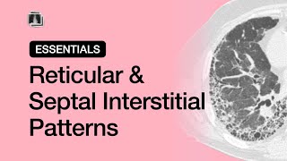 Reticular amp Septal Interstitial Patterns  Chest Radiology Essentials [upl. by Joli50]