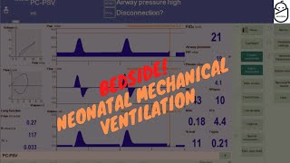 Bedside Neonatal Mechanical ventilation [upl. by Ahsinawt]