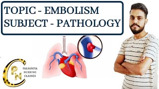 EmbolismDefinitiontypesPathogenesis Clinical manifestations Embolism in hindi by Palsaniya Sir [upl. by Aloisius]