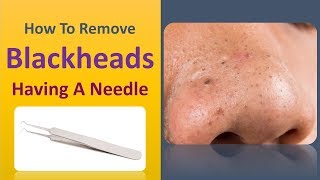 How to Remove Blackheads having a needle [upl. by Ehtylb650]