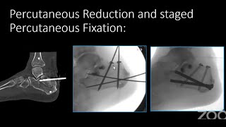 From MIS to mis Evolution of Calcaneal Fracture Management [upl. by Octavie]