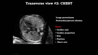 Cardiac Imaging in Early Gestation From Basic to Advanced [upl. by Nialb]