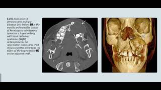 Neurofibromatosis neckㅣfibrous dysplasiaㅣCHARGE syndrome [upl. by Randee]