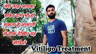 Vitiligo Vlogger मेरा सफेद दाग हुआ ठीक जानें कैसे [upl. by Haymes]