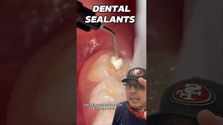 Step by Step Dental Sealants Procedure  In Office to Hands On Dental Training shorts [upl. by Malik]