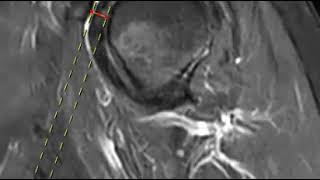 Coracoid impingement [upl. by Schrader]