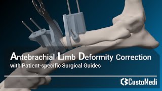 Antebrachial limb deformity correction with patientspecific surgical guides [upl. by Birdie]