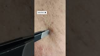 Plucking Stuborn Hairs SATISFYING Facial Hair Extraction [upl. by Amend]