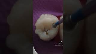 dentalcaries cavite dentist smiledental dentalsmiledesigning [upl. by Carolyne]