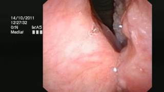 Cancer of the larynx voicebox  wwwdrjeevecom [upl. by Major]