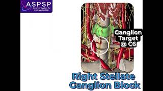 Stellate Ganglion Block [upl. by Rapsac943]