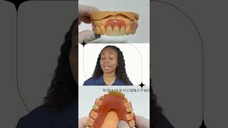 Flexible Partial Dentures for the Front Missing Teeth [upl. by Kumler]