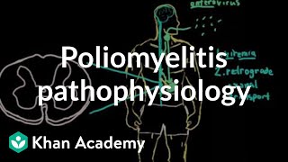 Poliomyelitis pathophysiology  Infectious diseases  NCLEXRN  Khan Academy [upl. by Swor]