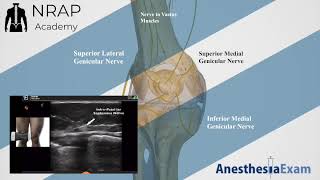 Failed Deep Genicular RFA Anterior Femoral Cutaneous Nerve amp Infrapatellar Saphenous Nerve Block [upl. by Lodie]